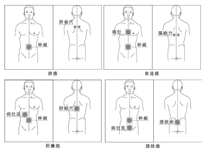 痛点(前胸患处相对应位置),对应俞穴(详见说明书或20)示意图上的位置)