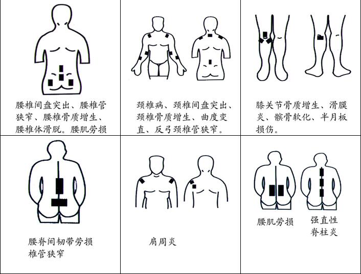 17 膏药常用位置臼疽馔